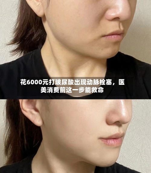 花6000元打玻尿酸出现动脉栓塞，医美消费前这一步能救命