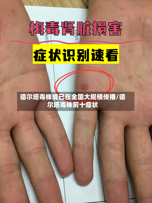 德尔塔毒株或已在全国大规模传播/德尔塔毒株前十症状-第2张图片