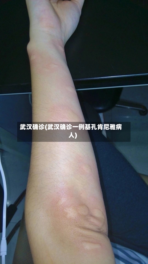 武汉确诊(武汉确诊一例基孔肯尼雅病人)