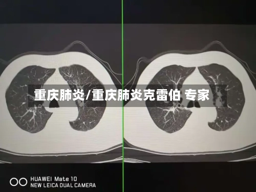 重庆肺炎/重庆肺炎克雷伯 专家-第2张图片